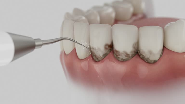 Reliable Dental Implants contractor in Hillsboro, MO by Smile Center Dentistry